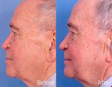 Revision Rhinoplasty Before and After Photos in Sewell, NJ, Patient 7620