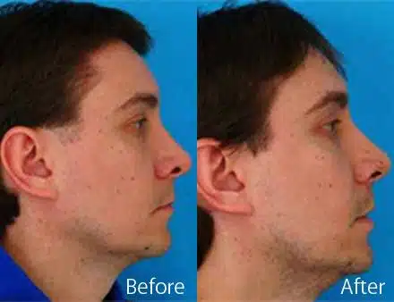 Revision Rhinoplasty Before and After Photos in Sewell, NJ, Patient 7647