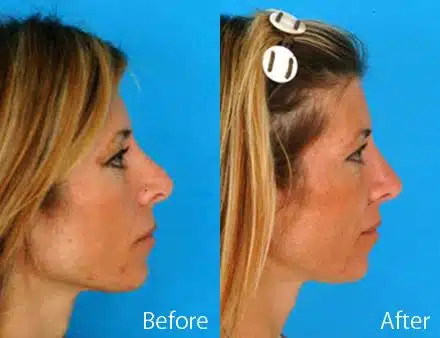 Revision Rhinoplasty Before and After Photos in Sewell, NJ, Patient 7649