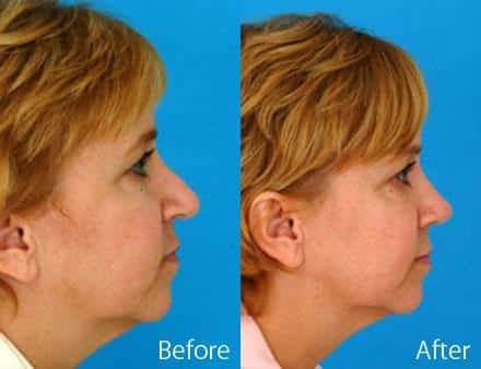 Revision Rhinoplasty Before and After Photos in Sewell, NJ, Patient 7651