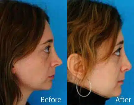 Revision Rhinoplasty Before and After Photos in Sewell, NJ, Patient 7653