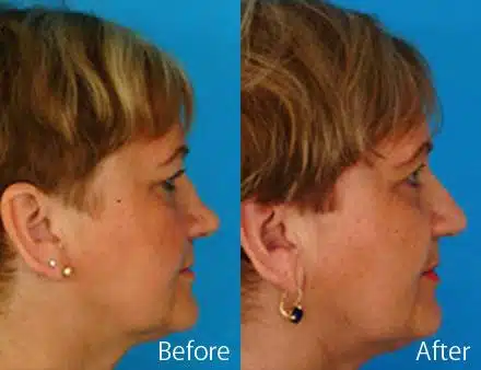 Revision Rhinoplasty Before and After Photos in Sewell, NJ, Patient 7655