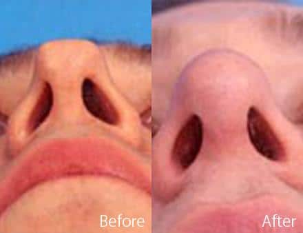 Revision Rhinoplasty Before and After Photos in Sewell, NJ, Patient 7659