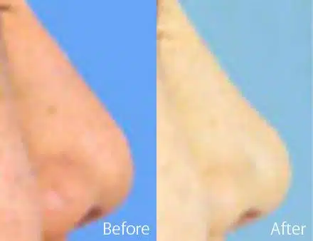 Revision Rhinoplasty Before and After Photos in Sewell, NJ, Patient 7661