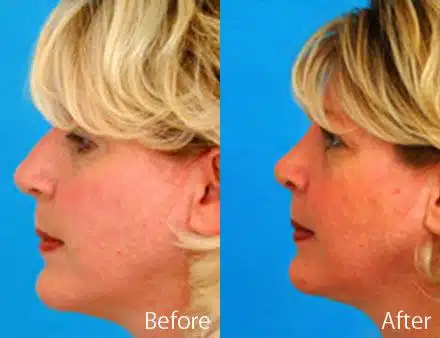 Revision Rhinoplasty Before and After Photos in Sewell, NJ, Patient 7669