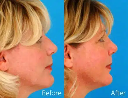 Revision Rhinoplasty Before and After Photos in Sewell, NJ, Patient 7669