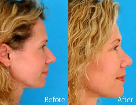 Revision Rhinoplasty Before and After Photos in Sewell, NJ, Patient 7712