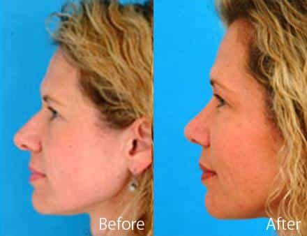 Revision Rhinoplasty Before and After Photos in Sewell, NJ, Patient 7712