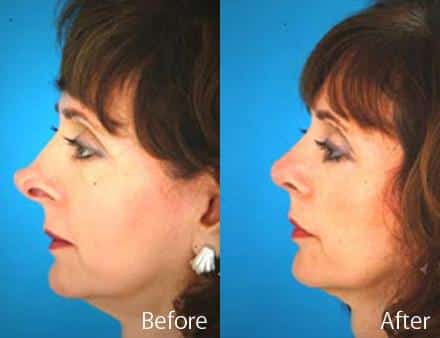 Revision Rhinoplasty Before and After Photos in Sewell, NJ, Patient 7718