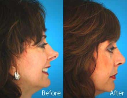 Revision Rhinoplasty Before and After Photos in Sewell, NJ, Patient 7718