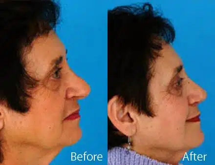 Revision Rhinoplasty Before and After Photos in Sewell, NJ, Patient 7725