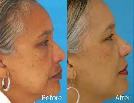 Revision Rhinoplasty Before and After Photos in Sewell, NJ, Patient 7727