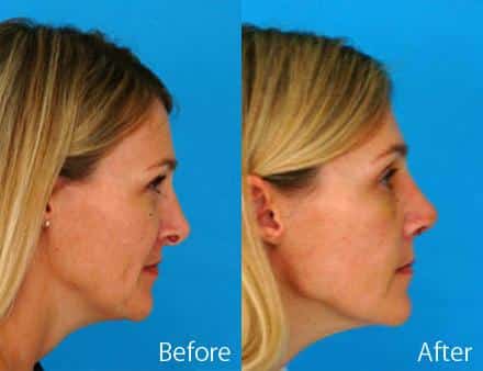 Revision Rhinoplasty Before and After Photos in Sewell, NJ, Patient 7730