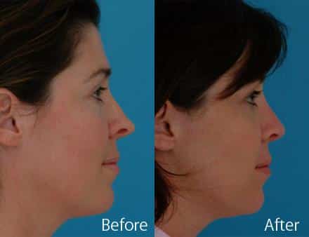 Revision Rhinoplasty Before and After Photos in Sewell, NJ, Patient 7732