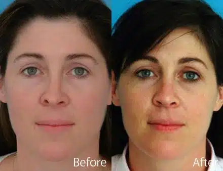 Revision Rhinoplasty Before and After Photos in Sewell, NJ, Patient 7732