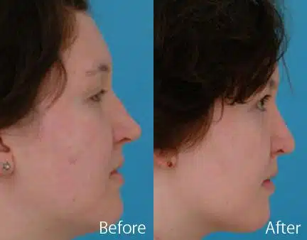 Revision Rhinoplasty Before and After Photos in Sewell, NJ, Patient 7735