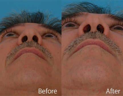 Revision Rhinoplasty Before and After Photos in Sewell, NJ, Patient 7738