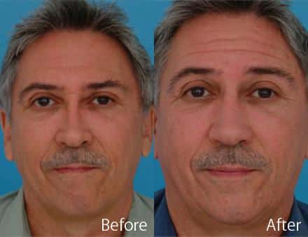 Revision Rhinoplasty Before and After Photos in Sewell, NJ, Patient 7738