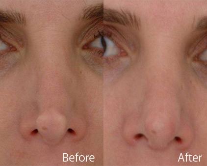 Revision Rhinoplasty Before and After Photos in Sewell, NJ, Patient 7763