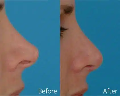 Revision Rhinoplasty Before and After Photos in Sewell, NJ, Patient 7765