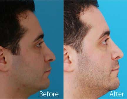 Revision Rhinoplasty Before and After Photos in Sewell, NJ, Patient 7770