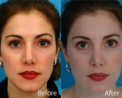 Revision Rhinoplasty Before and After Photos in Sewell, NJ, Patient 7773