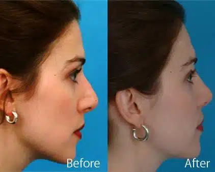 Revision Rhinoplasty Before and After Photos in Sewell, NJ, Patient 7773