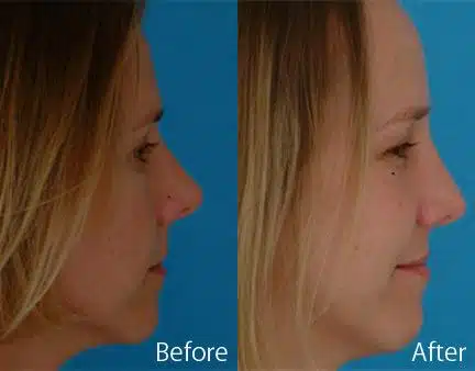 Revision Rhinoplasty Before and After Photos in Sewell, NJ, Patient 7780