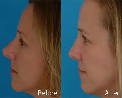 Revision Rhinoplasty Before and After Photos in Sewell, NJ, Patient 7780