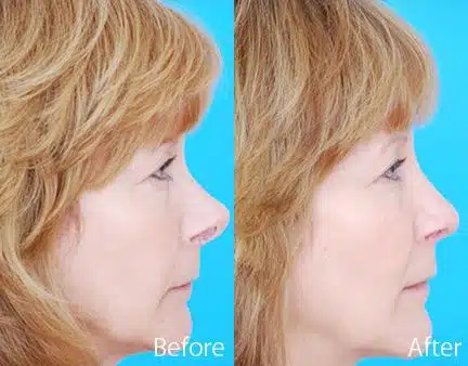 Revision Rhinoplasty Before and After Photos in Sewell, NJ, Patient 7791