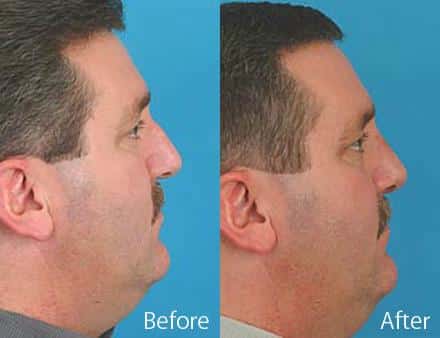 Twisted Nose Before and After Photos in Sewell, NJ, Patient 7857