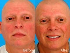 Twisted Nose Before and After Photos in Sewell, NJ, Patient 7860