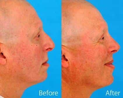 Twisted Nose Before and After Photos in Sewell, NJ, Patient 7860