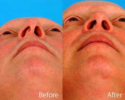 Twisted Nose Before and After Photos in Sewell, NJ, Patient 7860