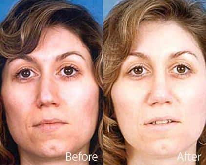 Twisted Nose Before and After Photos in Sewell, NJ, Patient 7870