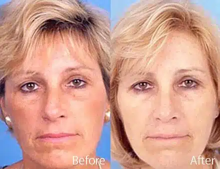 Twisted Nose Before and After Photos in Sewell, NJ, Patient 7872