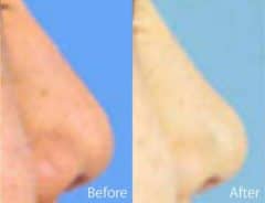 Underprojected Before and After Photos in Sewell, NJ, Patient 7874