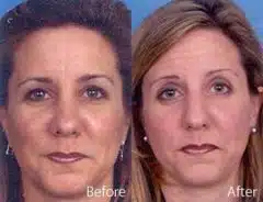 Wide Nose Before and After Photos in Sewell, NJ, Patient 7902