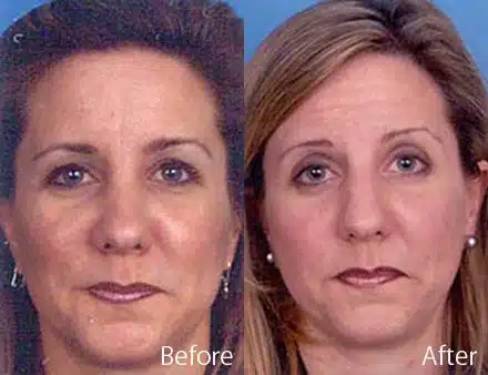 Wide Nose Before and After Photos in Sewell, NJ, Patient 7902