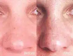 Wide Nose Before and After Photos in Sewell, NJ, Patient 7904