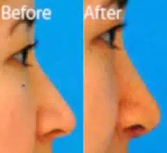 Ethnic Rhinoplasty Before and After Photos in Sewell, NJ, Patient 7135