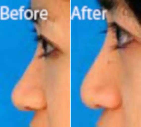 Ethnic Rhinoplasty Before and After Photos in Sewell, NJ, Patient 7137