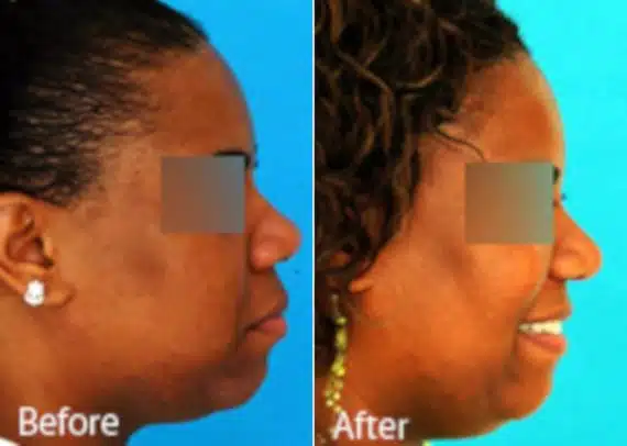 Ethnic Rhinoplasty Before and After Photos in Sewell, NJ, Patient 7141