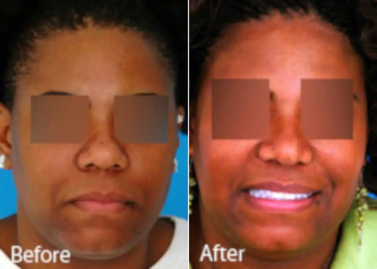 Ethnic Rhinoplasty Before and After Photos in Sewell, NJ, Patient 7141