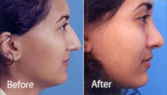 Ethnic Rhinoplasty Before and After Photos in Sewell, NJ, Patient 7147