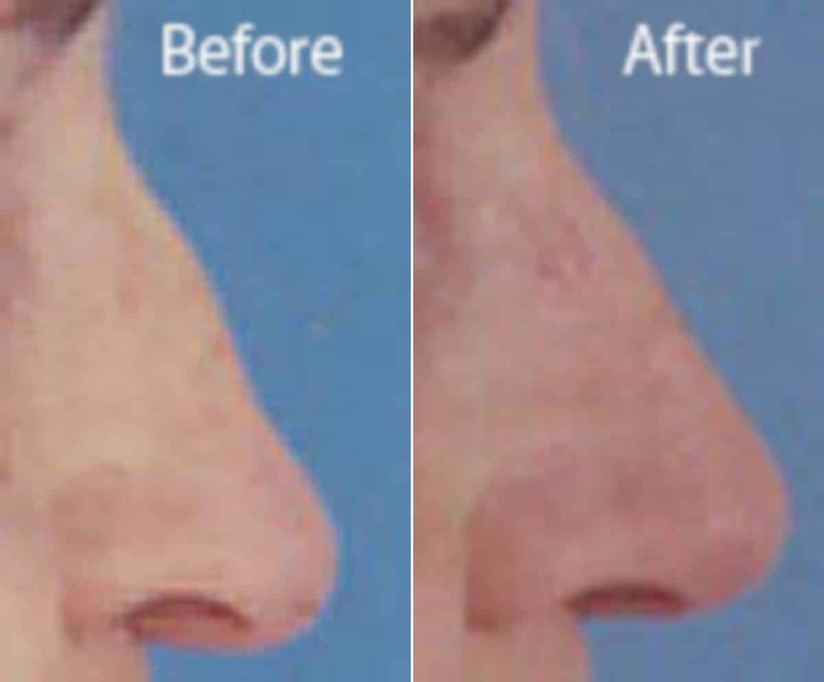 Revision Rhinoplasty Before and After Photos in Sewell, NJ, Patient 7667