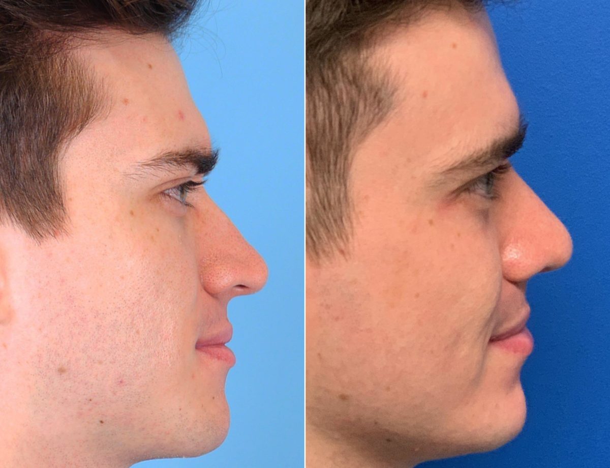 Twisted Nose Before and After Photos in Sewell, NJ, Patient 8391