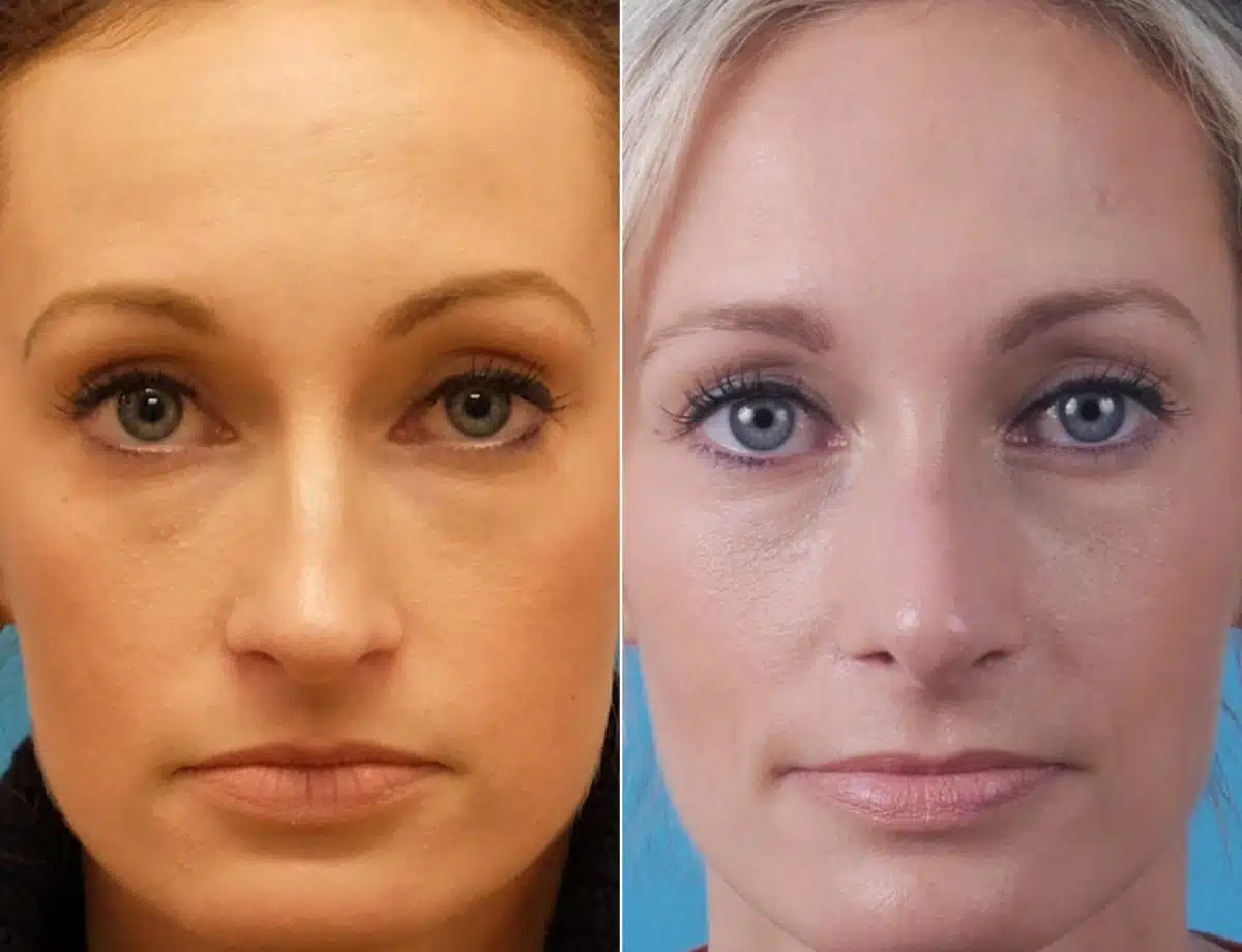 Large Nose Before and After Photos in Sewell, NJ, Patient 8522