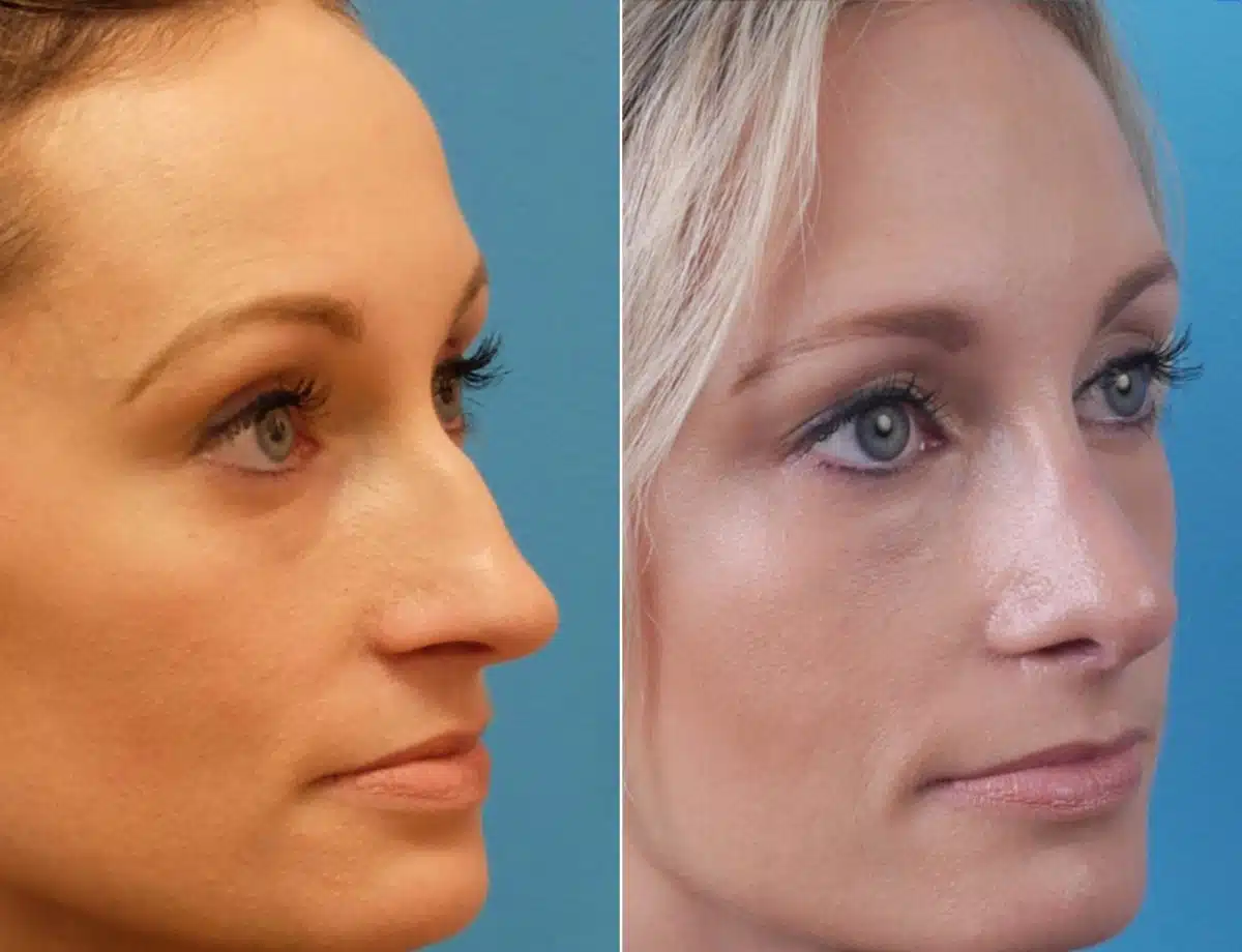 Large Nose Before and After Photos in Sewell, NJ, Patient 8522