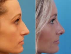 Large Nose Before and After Photos in Sewell, NJ, Patient 8522